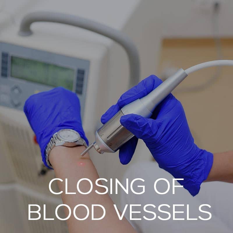 closing of blood vessels