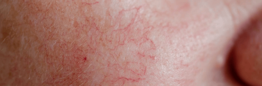 NY ENLARGED BLOOD VESSELS and ERYTHEMA